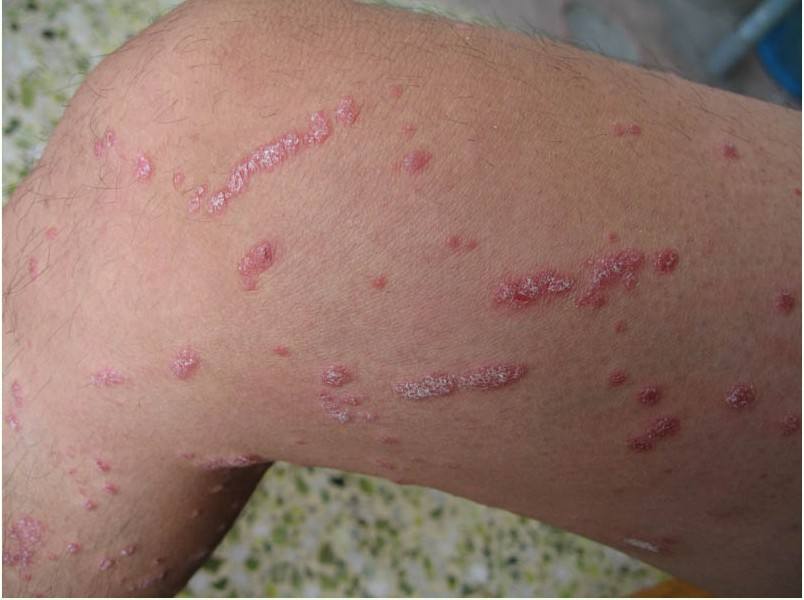 牛皮癣该如何是好