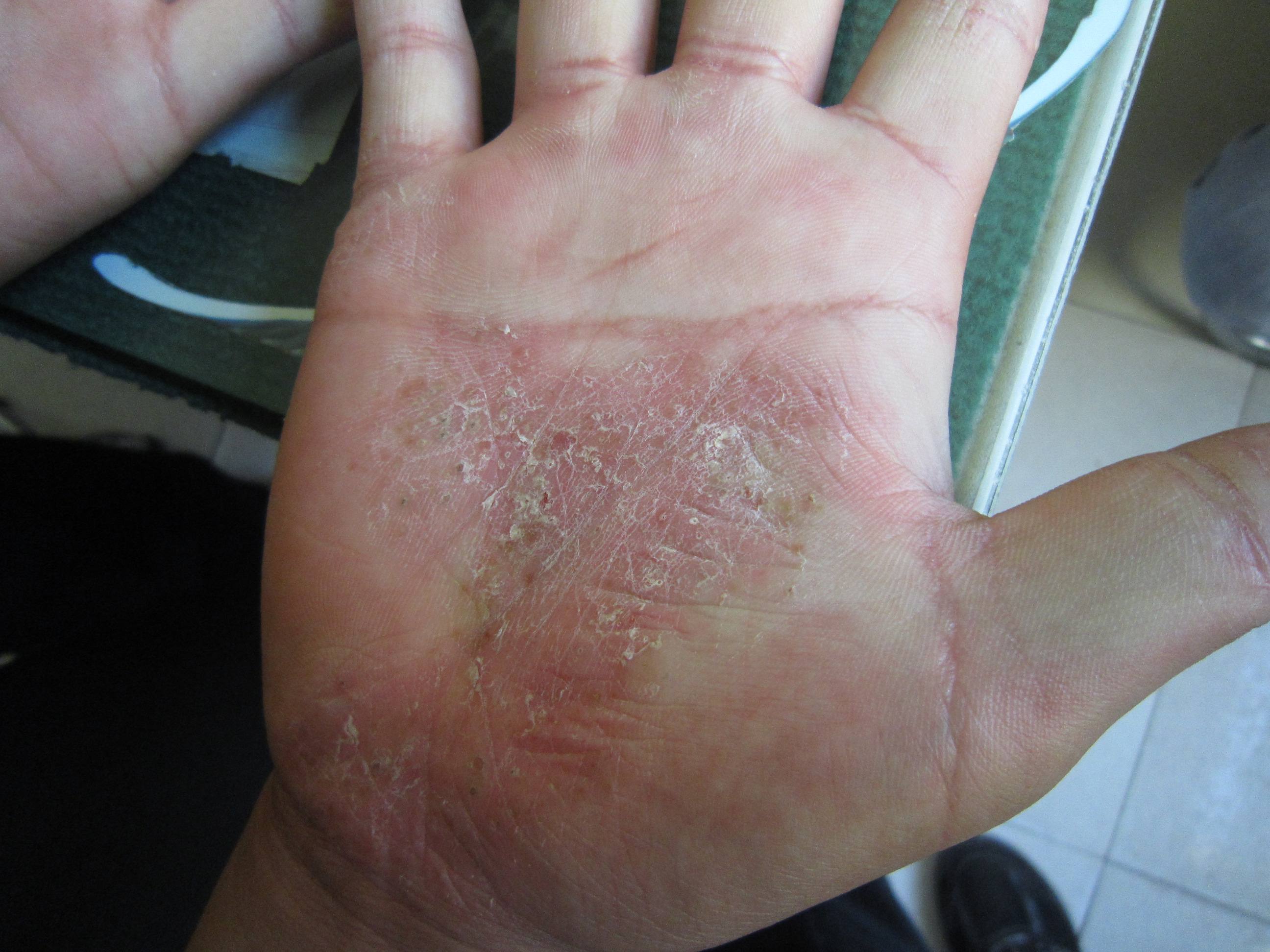 得了银血病会有生命危险吗?