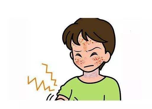 危害必定存在的银屑病遗传率高吗