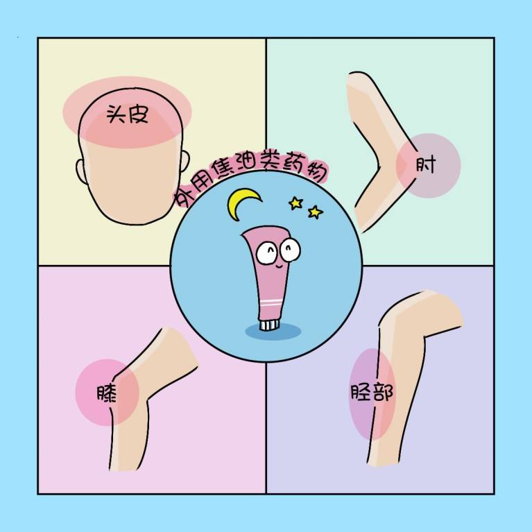 为何发生银屑病典型的病因