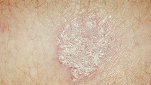 出现牛皮癣要怎么护理