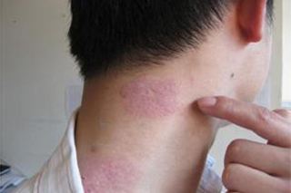 怎么做可防止头部银屑病症状增加