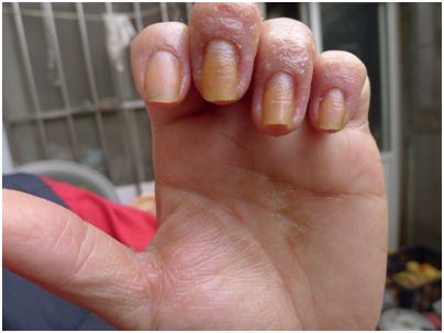 有牛皮皮癣后的常见病症有什么?