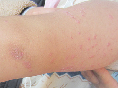 牛皮癣会遗传吗