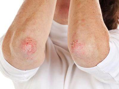 做到这些不让银屑病加重