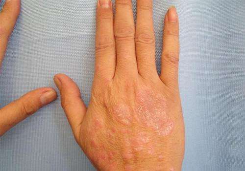 手部牛皮藓如何护理
