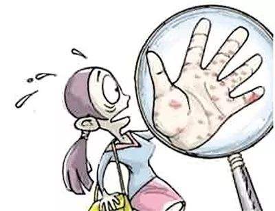 牛皮藓的治疗方法有哪些