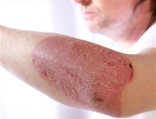 儿童诱发银屑病的原因