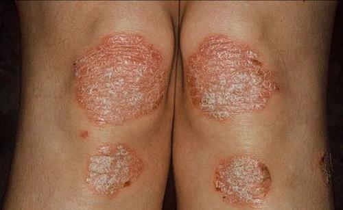 药物能把皮屑治好吗