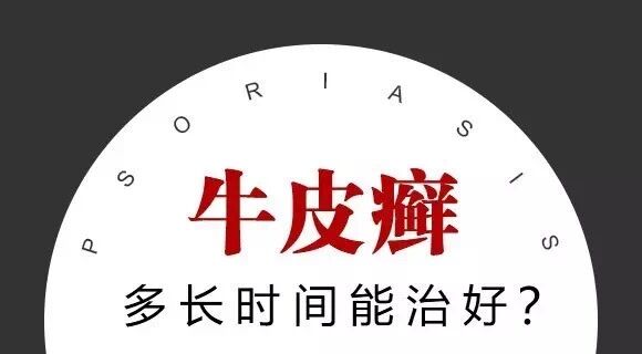 为何牛皮癣不复发