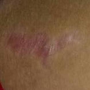 广州治疗银屑病