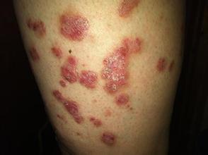 广州哪家医院治疗牛皮癣好专业一些