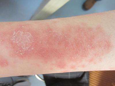 为什么牛皮鲜会经常发作