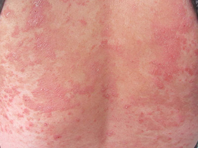 银屑病带给儿童的危害