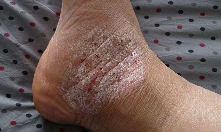 那么牛皮皮癣这个疾病是什么因素导致的呢?