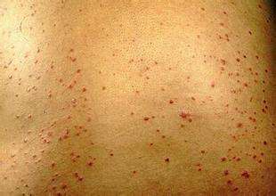 带你看红皮型牛皮癣的症状