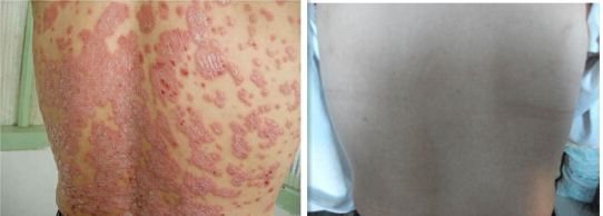 牛皮皮癣疤痕怎么消除的方法？